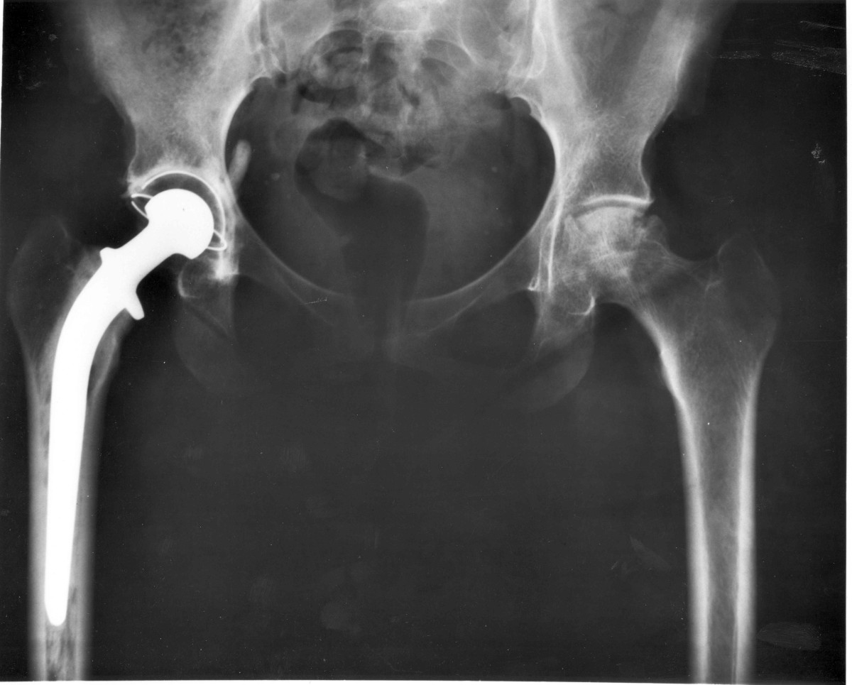 An X-ray shows a hip replacement.