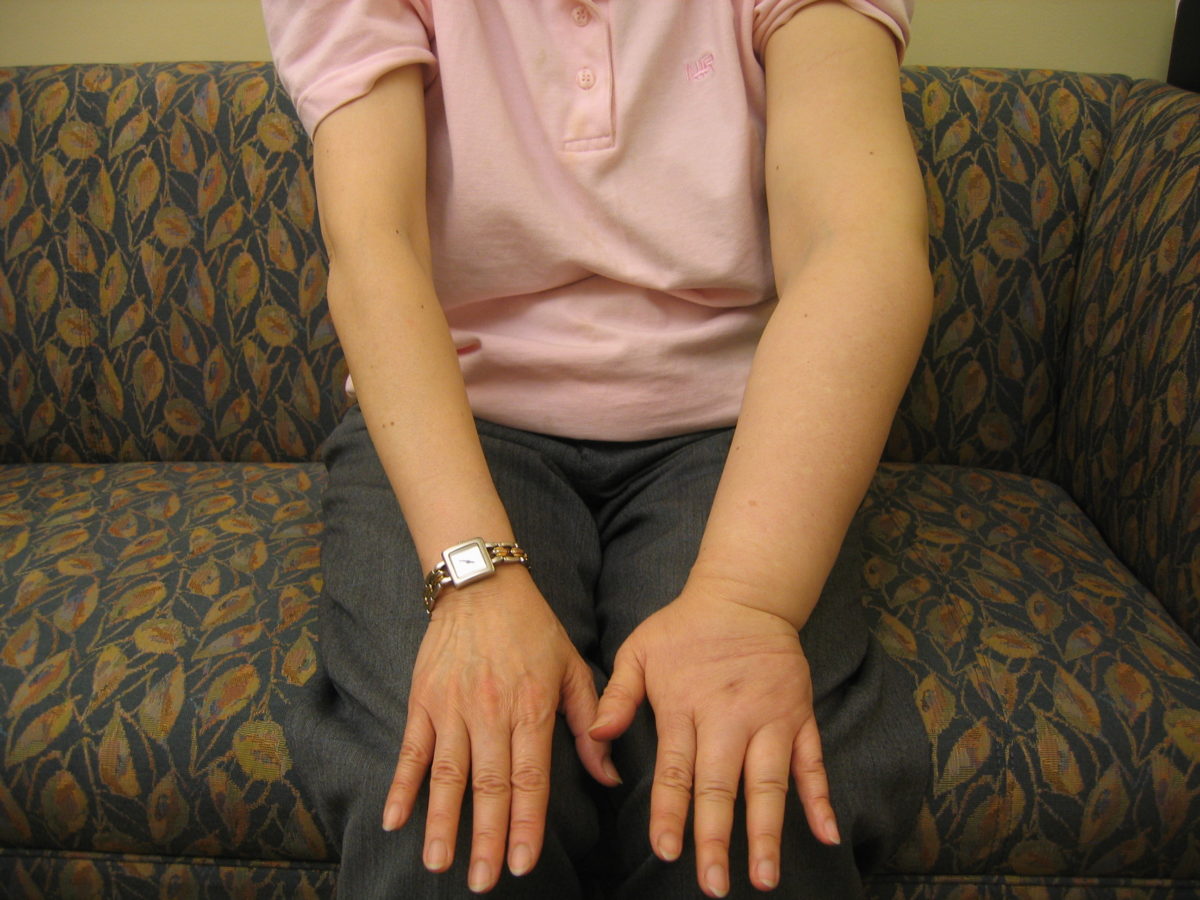 The patient's left arm is swollen due to lymphedema.